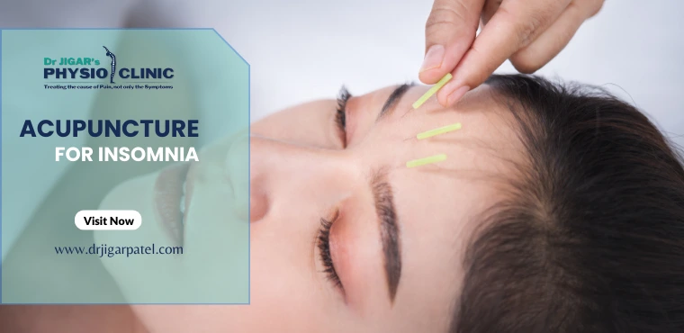  Acupuncture for Insomnia 