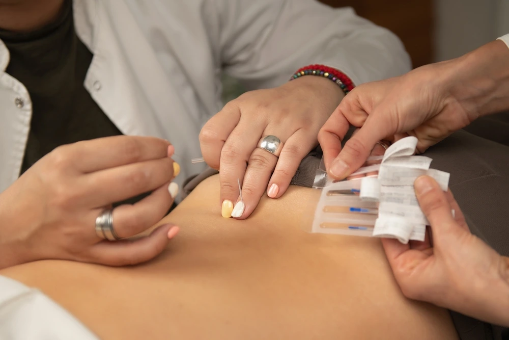  Acupuncture Treatment for Sciatica in Ahmedabad 