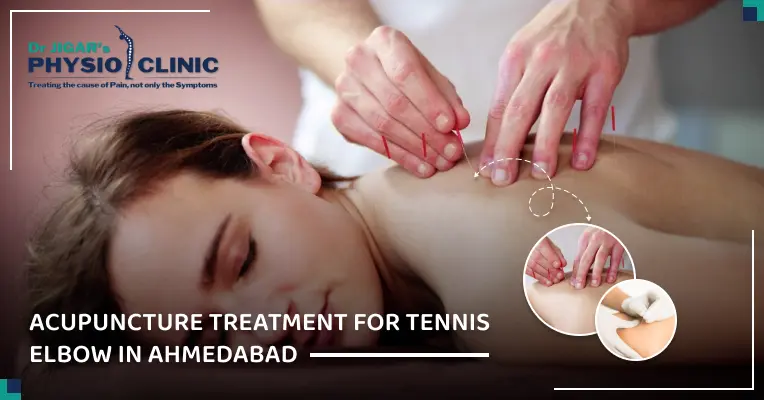  Acupuncture Treatment for Tennis Elbow in Ahmedabad